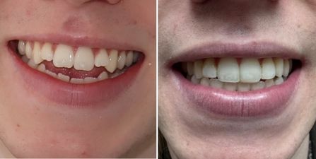 Invisalign Estepona